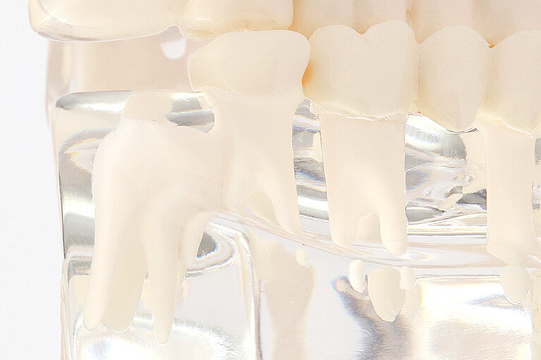 根管治療で悪化した歯を残す