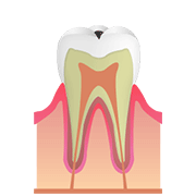 C1(エナメル質のむし歯)
