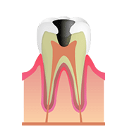 C3(歯髄のむし歯)