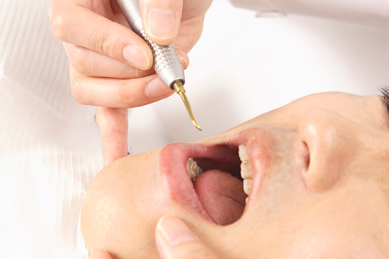 歯周病の進行と治療について